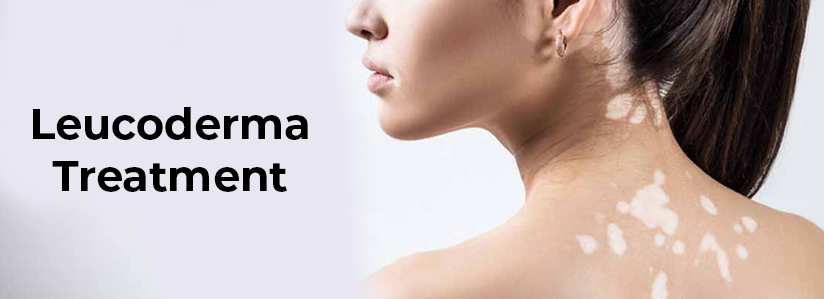 leucoderma-ayurvedic-treatment